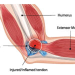 Πόνος στον αγκώνα: Τι μπορεί να συμβαίνει; Epikondilitida Epicondylitis