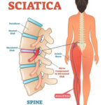 Ισχιαλγία: Ο πόνος στο πόδι που ταλαιπωρεί Isxialgia Sciatica