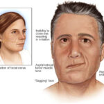 Πάρεση προσωπικού νεύρου Paresi Prosopikou Neurou – Facial Nerve Paresis