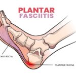 Πονάνε οι πτέρνες σας; Μπορεί να υπάρχει και λόγος Pelmatiaia Aponeurositida – Plantar Fasciitis
