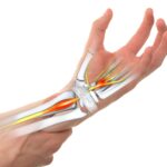 Σύνδρομο καρπιαίου σωλήνα: Οι 7 αιτίες που το προκαλούν Sindromo karpiaiou solina – Carpal tunnel syndrome